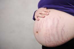 Как избежать растяжек во время беременности фото